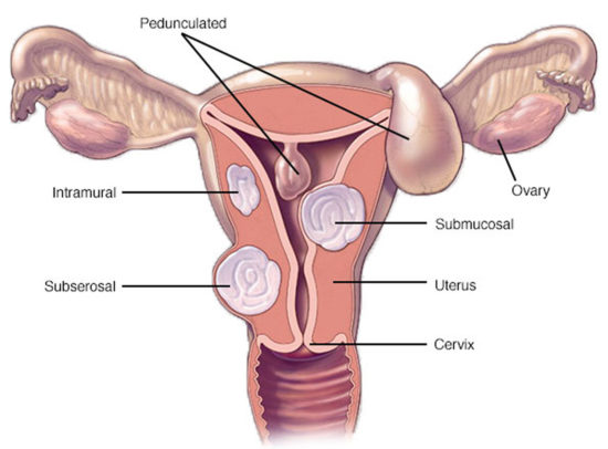 Common Concepts Causes Of Fibroid Formation And How To Avoid Them