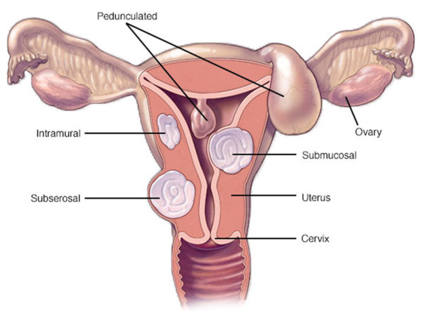 Common Concepts Causes Of Fibroid Formation And How To Avoid Them